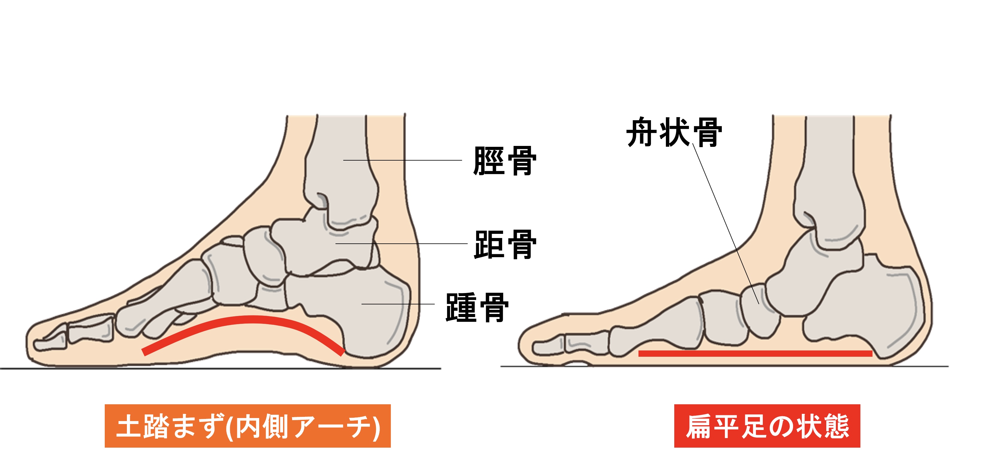 扁平足