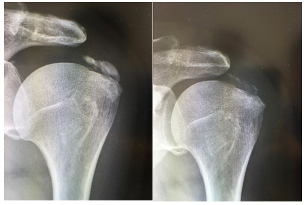 左肩石灰沈着性腱板炎患者さんのレントゲン写真